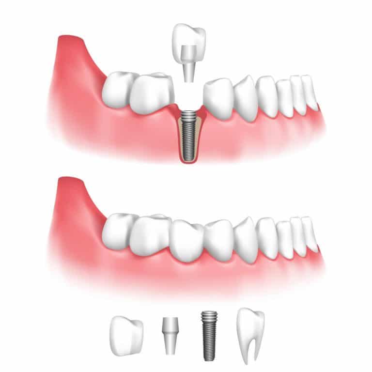 Les Avantages Des Implants Dentaires Implant Dentaire Tunisie Pas Cher